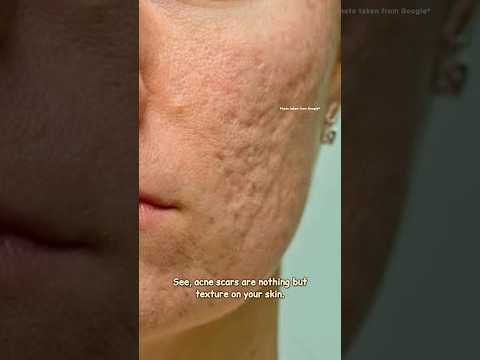 How to get rid of acne scars with Tretinoin | Acne scar Treatment #sristydutta #acnescars #shorts